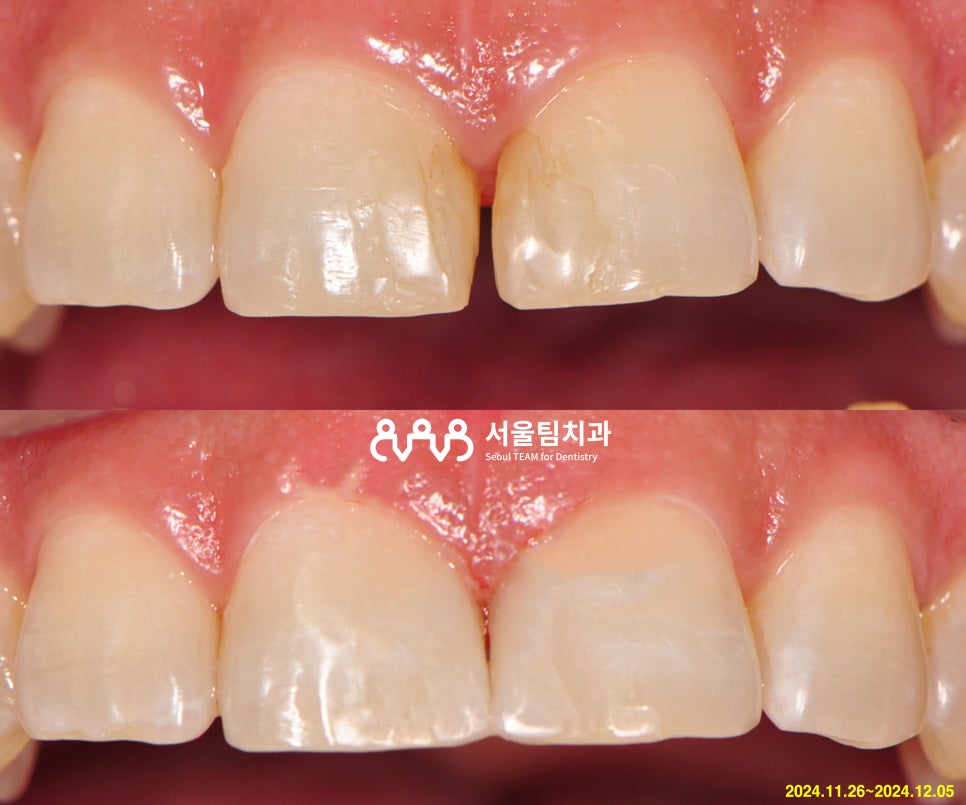 seoulteam smile design consultation