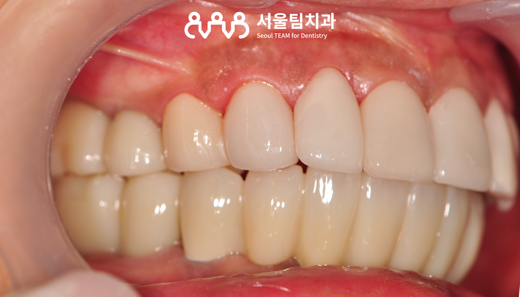 원신동치과 서울팀치과 루미네이트