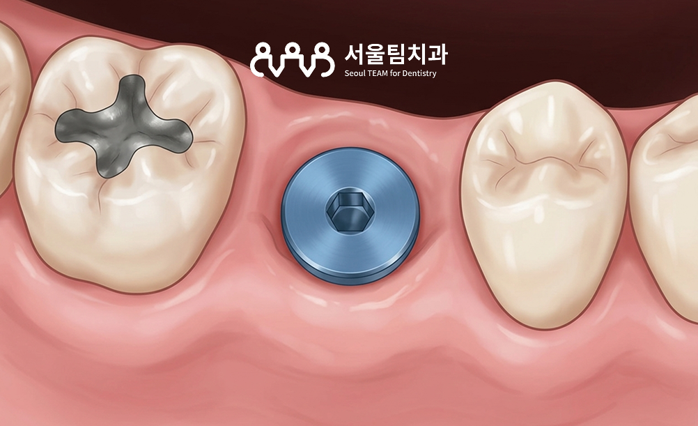 삼송역 무절개 임플란트 시술 장면