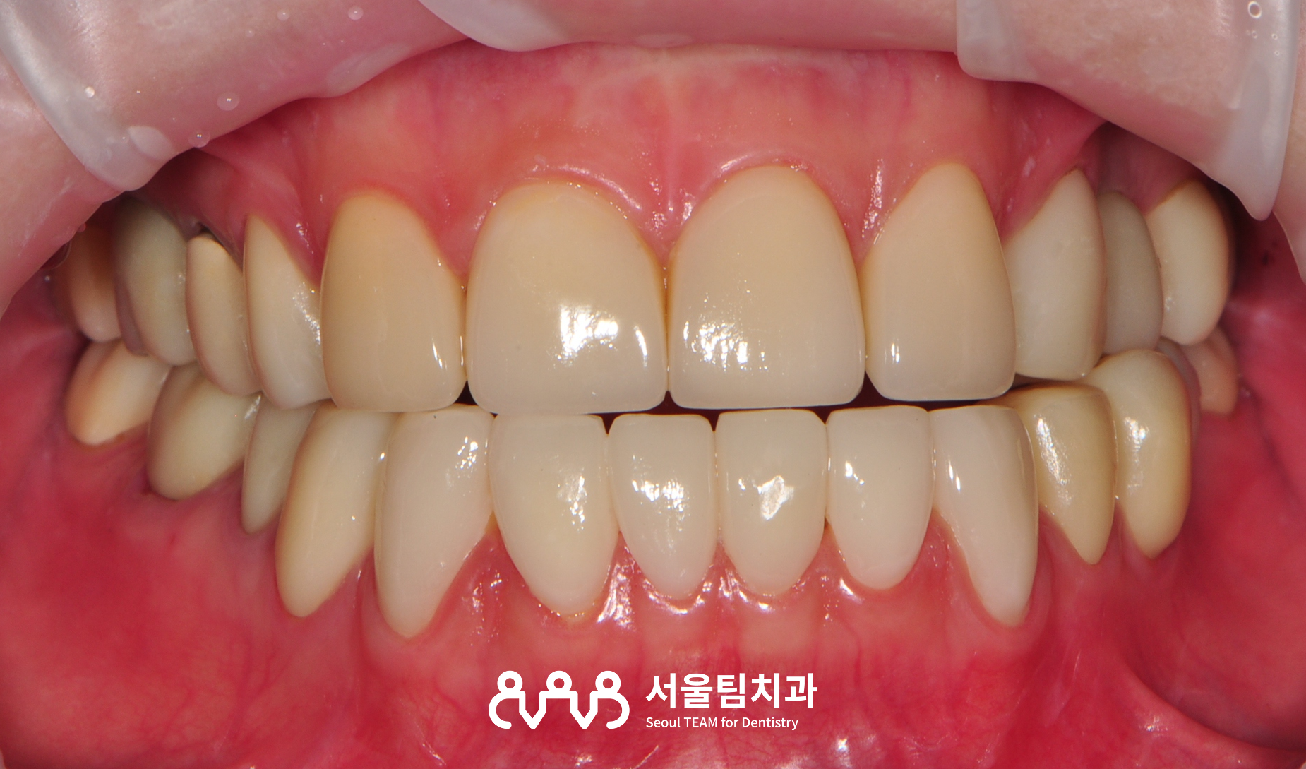 라미네이트 시술 후 정기 검진 — 접착 상태와 잇몸 건강 점검