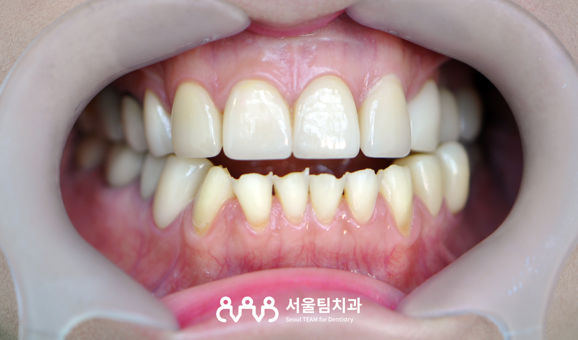 라미네이트 시술 전 — 접착 상태와 잇몸 건강 점검