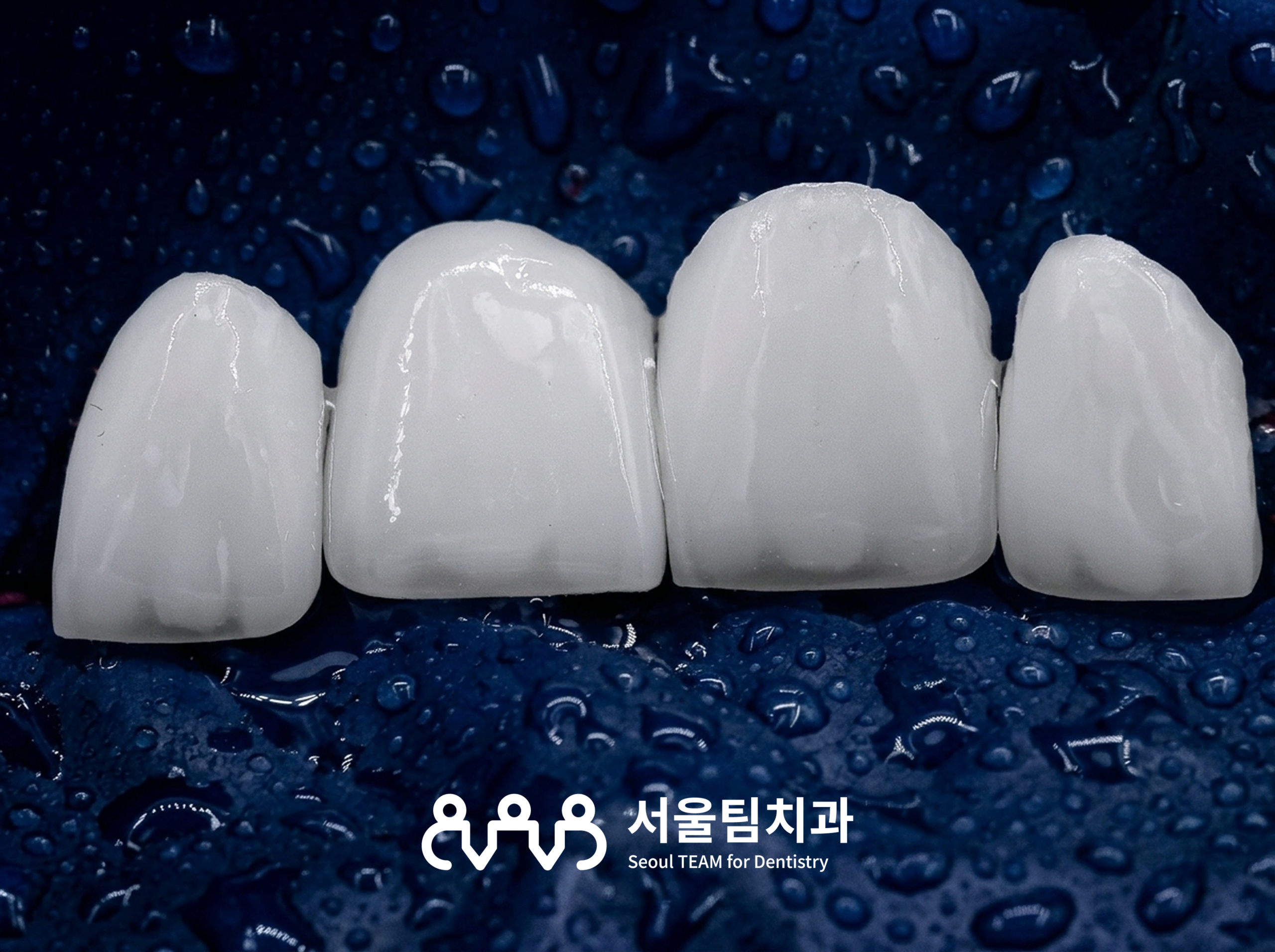 원신동치과 무삭제 라미네이트 상담 — 치아 삭제 없이 진행하는 라미네이트 안내