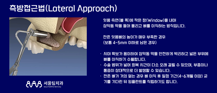삼송역치과 상악동 거상술 측방접근법 수술 원리