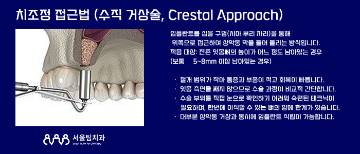 삼송역치과 상악동 거상술 치조정 접근법 수술 원리