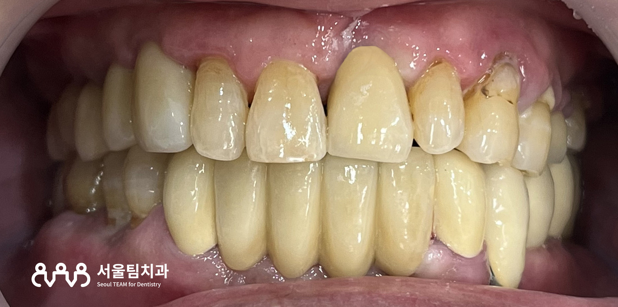 신원동치과 발치즉시 임플란트 보철 수복 완료 후 구내 정면 — 자연스러운 치열 회복/2024.11.13