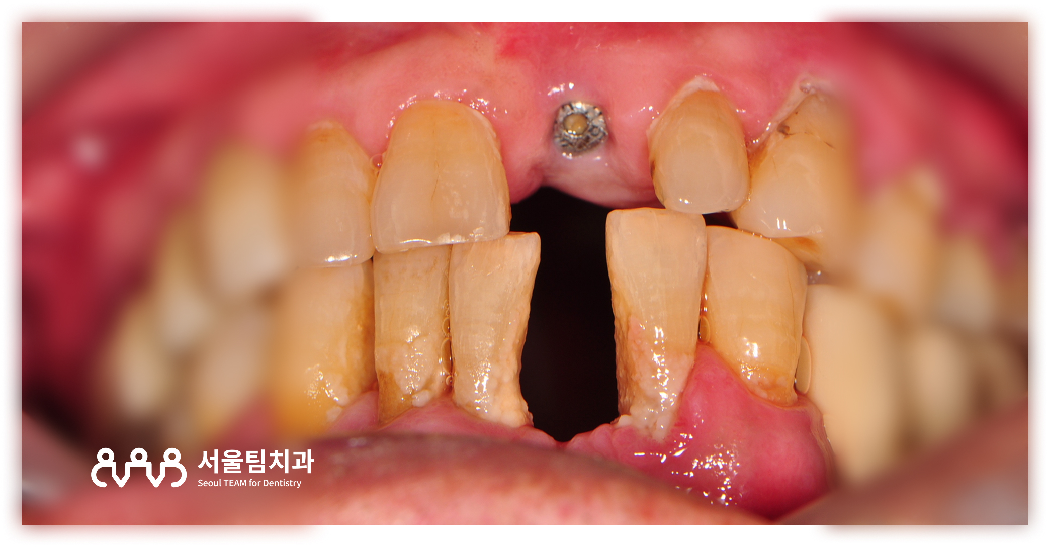 신원동치과 발치즉시 임플란트 식립 직후 구내 정면 — 픽스처 식립 상태