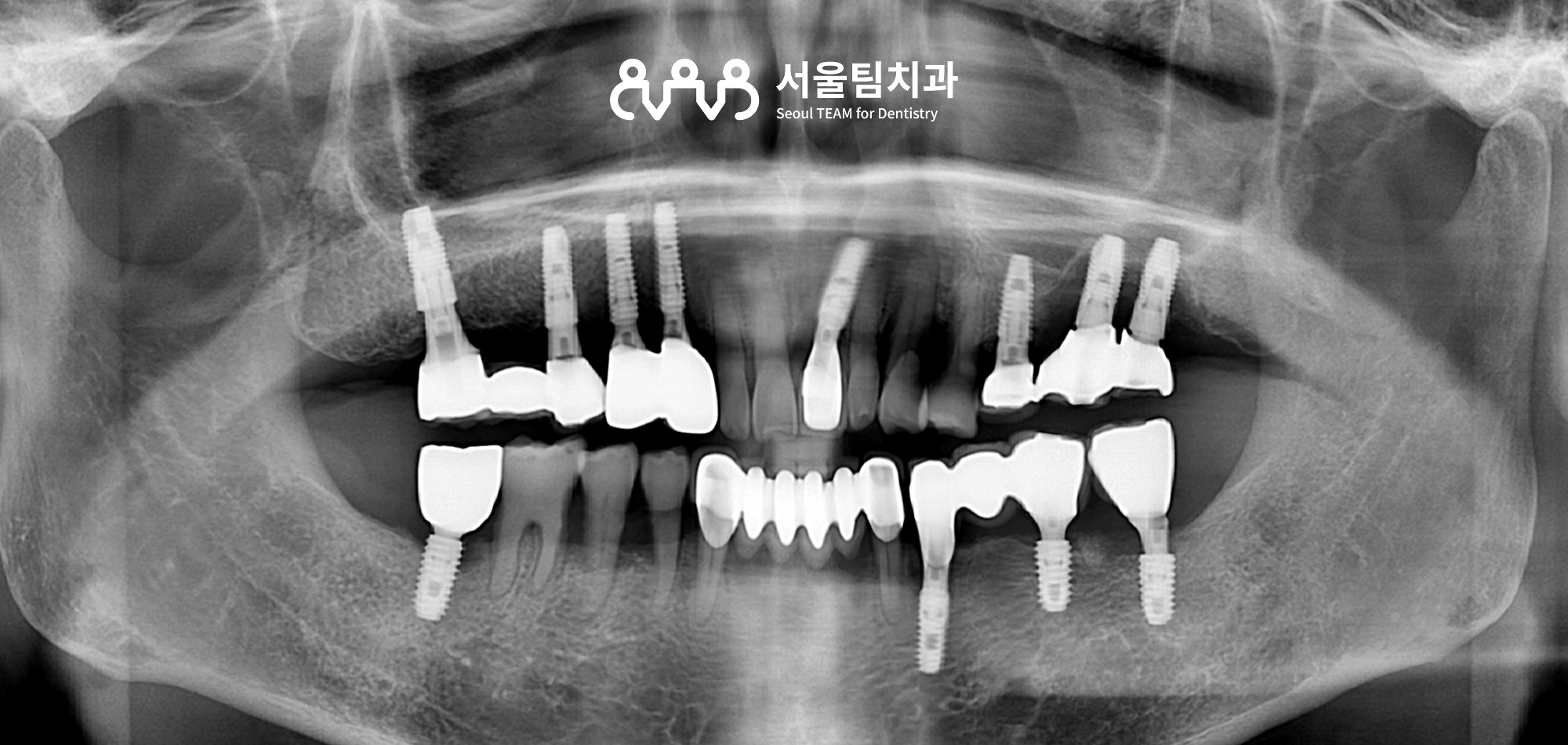 신원동치과 서울팀치과의원 발치즉시 임플란트 수복 완료 파노라마 엑스레이