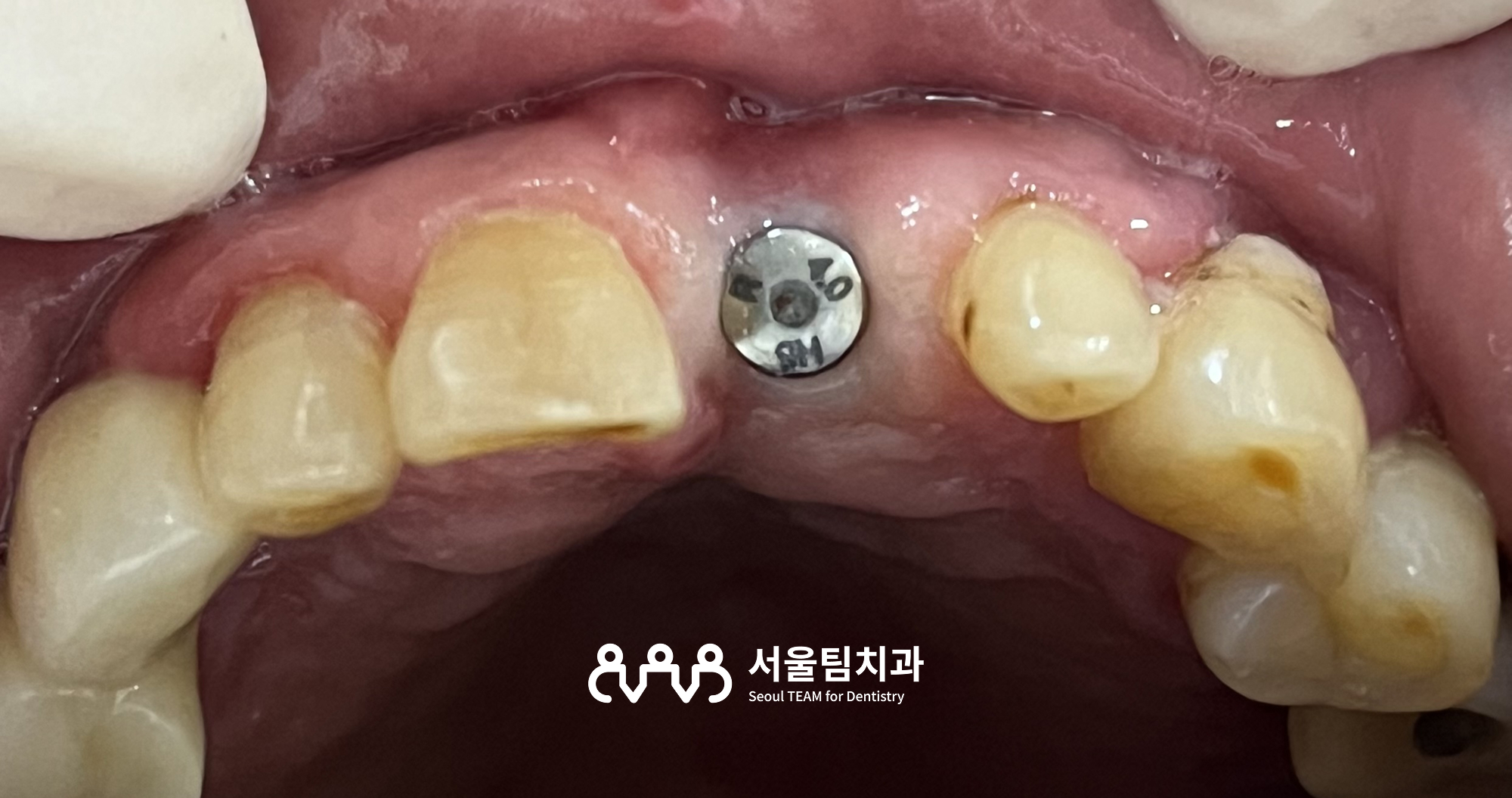 신원동치과 발치즉시 임플란트 식립 직후 구내 교합면 — 식립체 위치 확인
