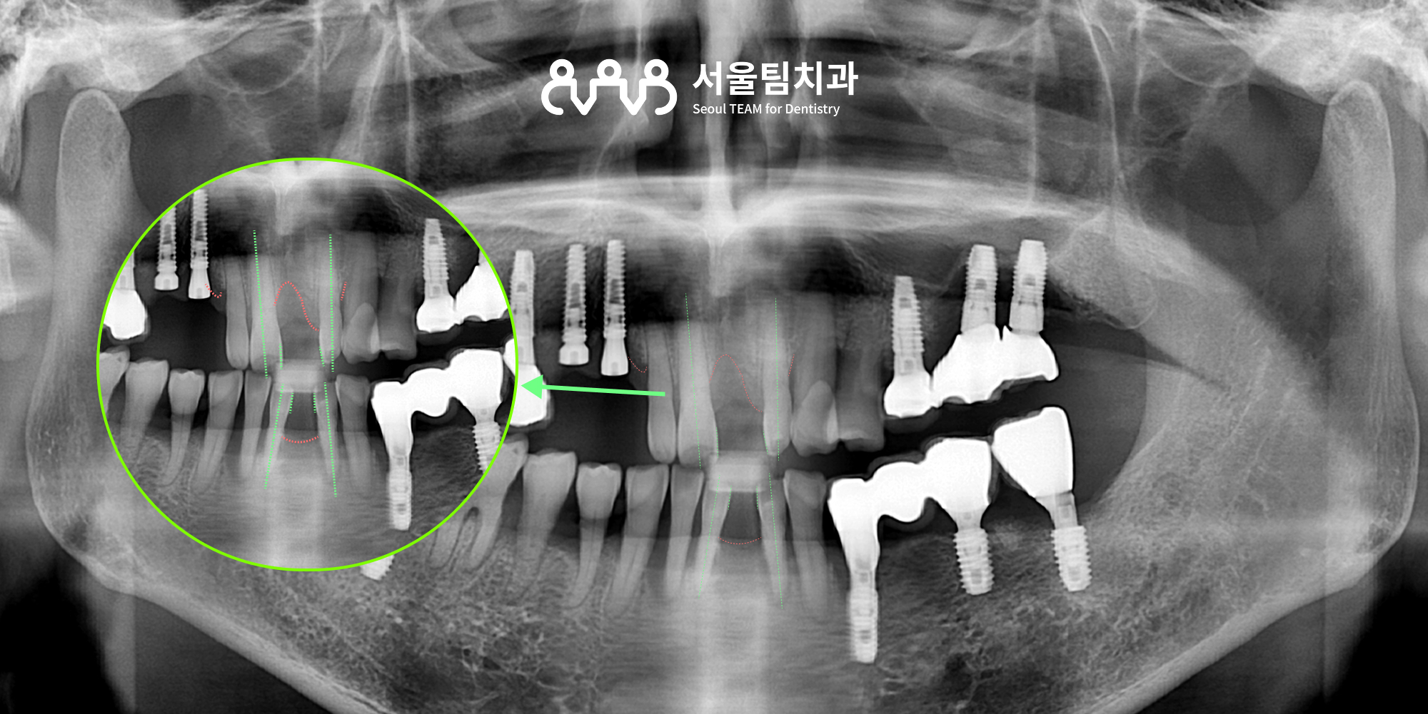 신원동치과 발치즉시 임플란트 식립 전 파노라마 — 치조골 높이·폭 분석