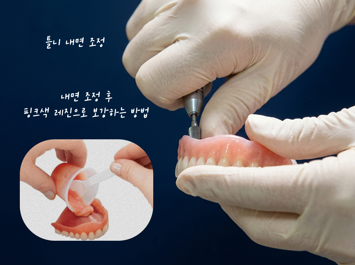 삼송동치과 틀니 리라이닝(재단장) 조정 과정