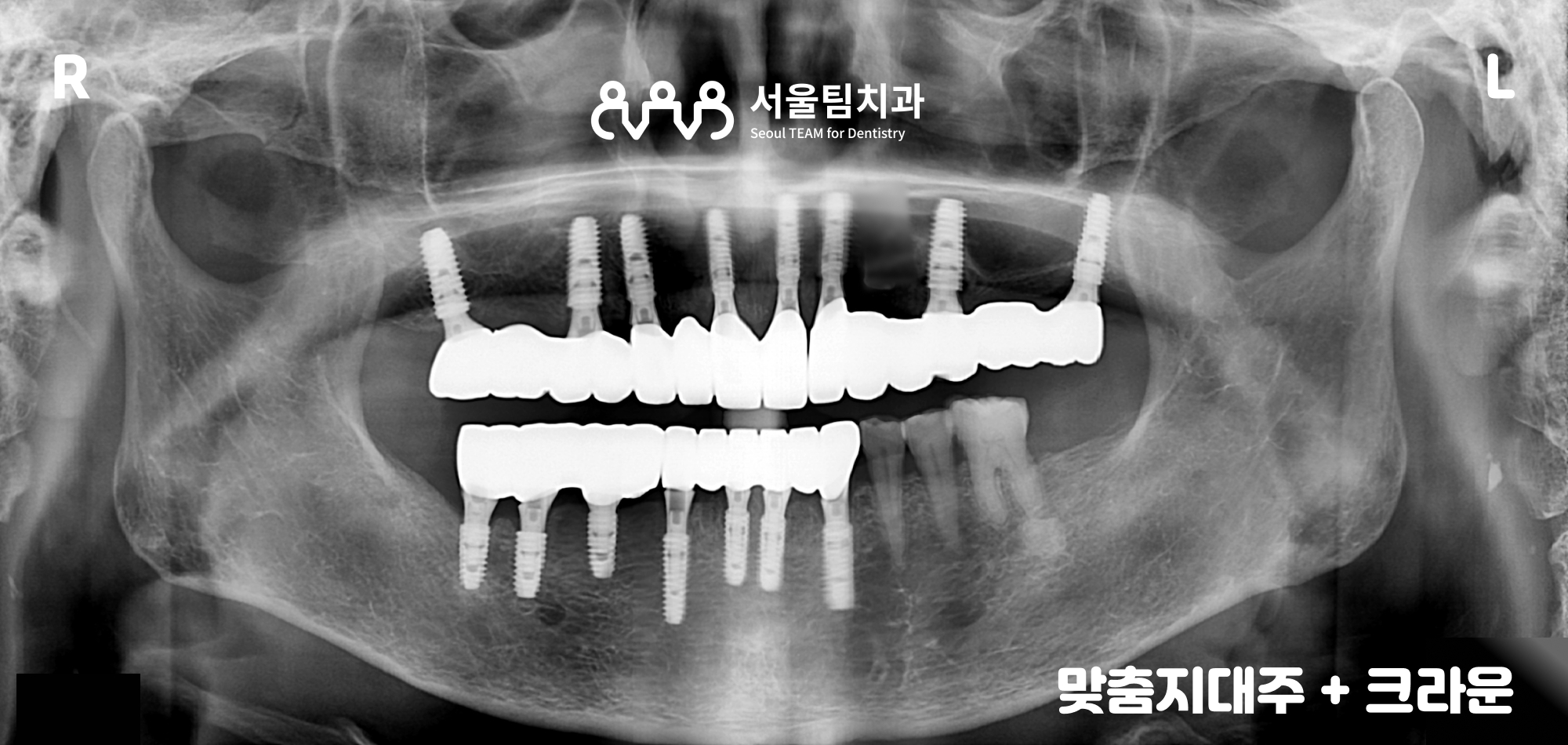 원신동치과 전악 임플란트 상부 보철 부착 완료 파노라마 — 교합·골유합 최종 확인