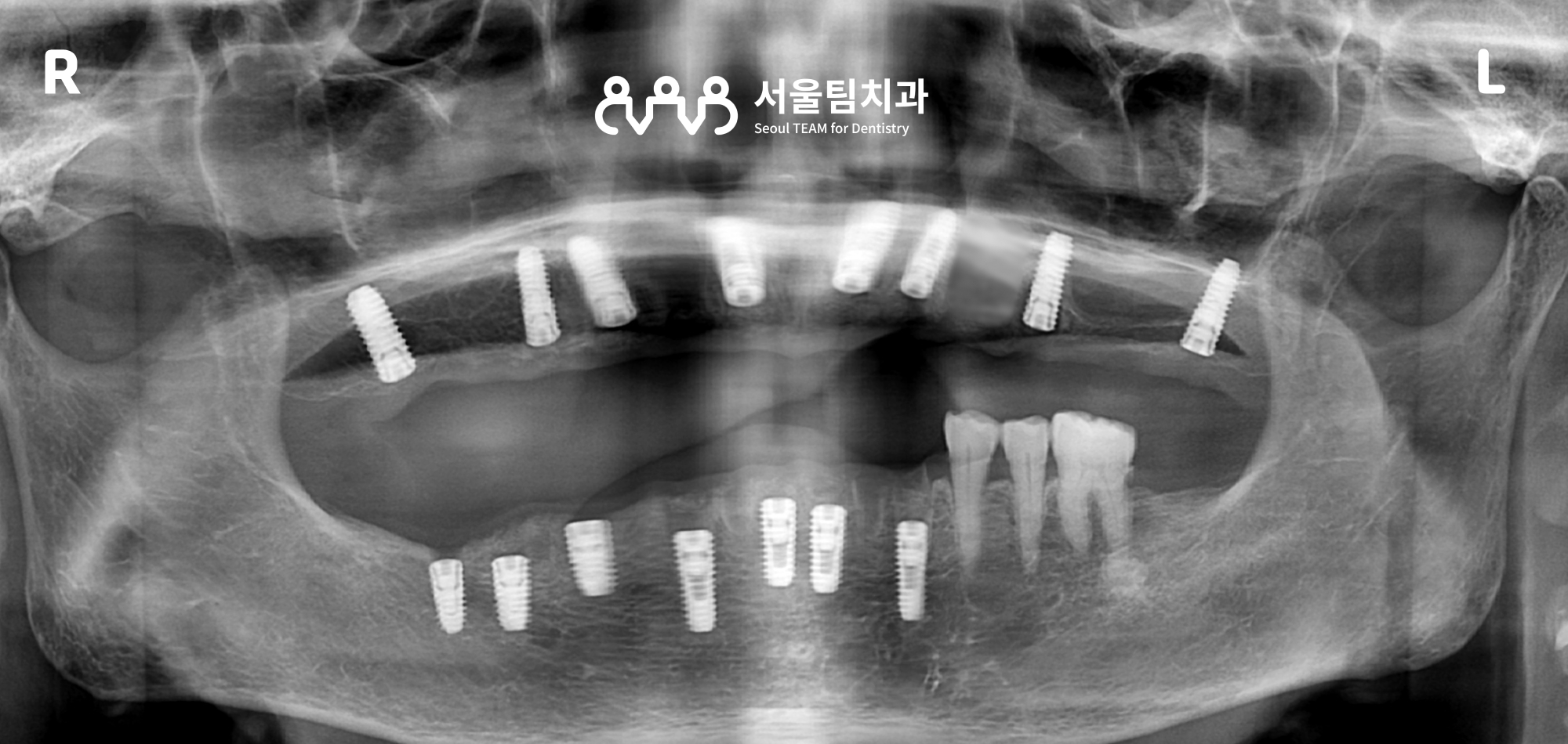 원신동치과 전악 임플란트 상악 픽스처 식립 직후 구내 사진