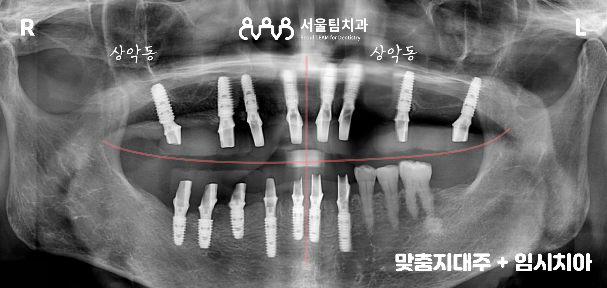 원신동치과 커스텀 어버트먼트 장착 후 임시 치아 부착 상태 — 보철 형태 및 교합 확인