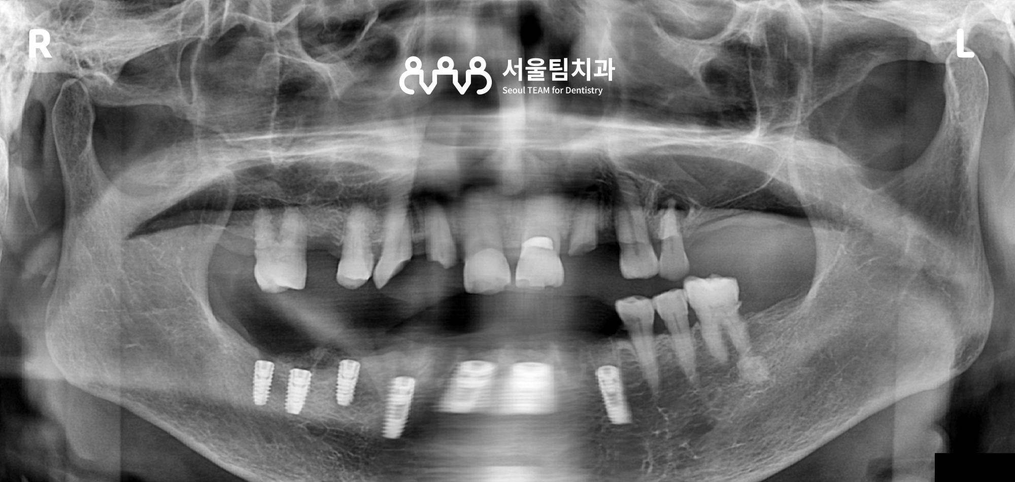 원신동치과 전악 임플란트 하악 픽스처 식립 직후 구내 사진